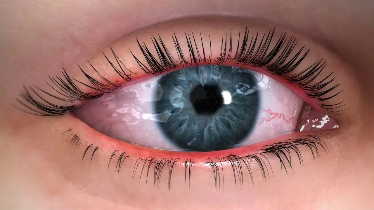 The Impact of Bacterial Eye Infections on Vision and Eye Health